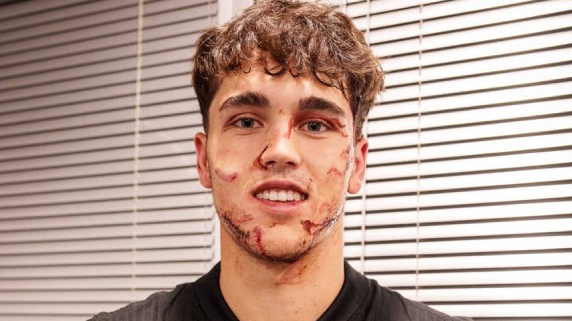 Kena Pul Sepatu, Pau Cubarsi Dapat 10 Jahitan